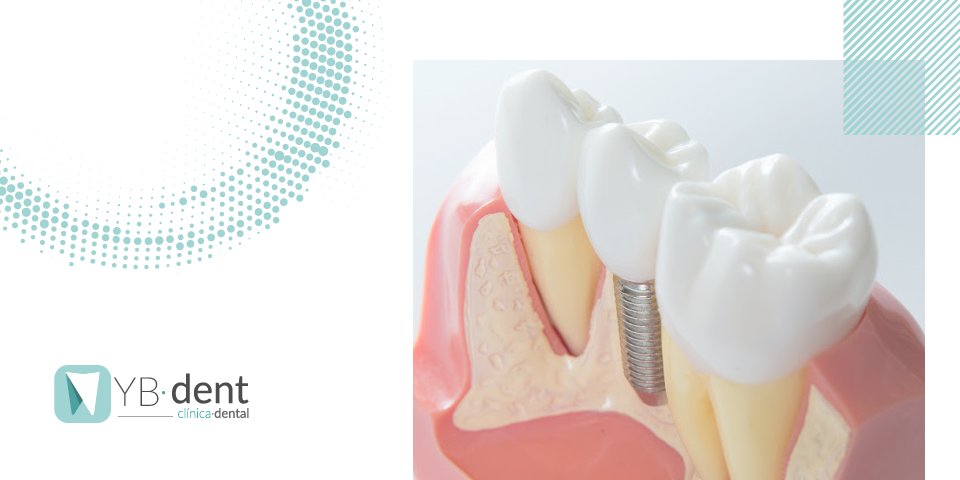 Descubre en que consiste la periimplantitis. ¿Cómo combatirla