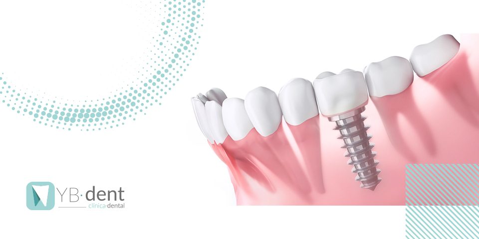 ¿Implantes dentales antes o después de la ortodoncia