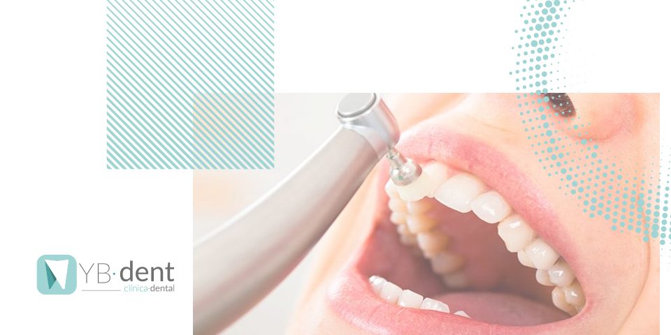 Limpieza dental en Valencia