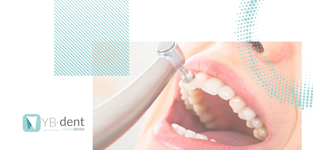 Limpieza dental en Valencia