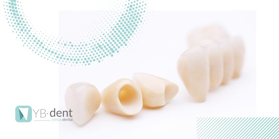 Fundas dentales ¿Cuándo debo usarlas