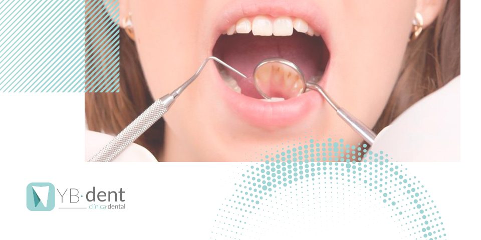 Cómo solucionar el sarro dental