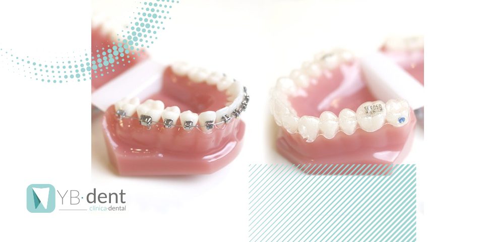 Diferencias entre Invisalign y brackets