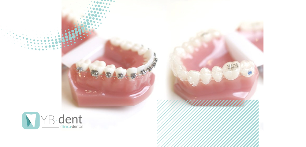 Diferencias entre Invisalign y brackets