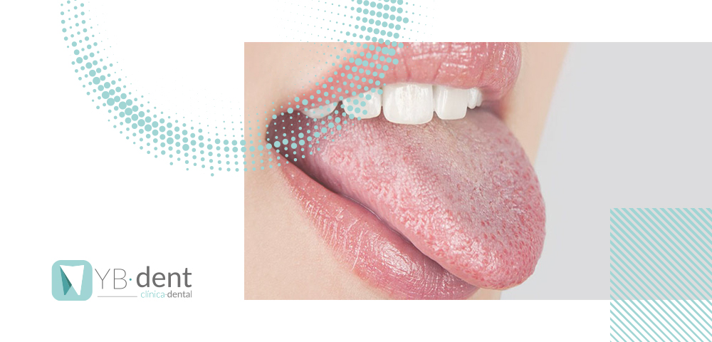 Xerostomía o síndrome de boca seca