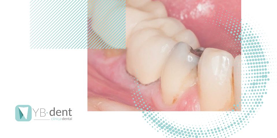 Qué son las caries interproximales y cuál es su tratamiento