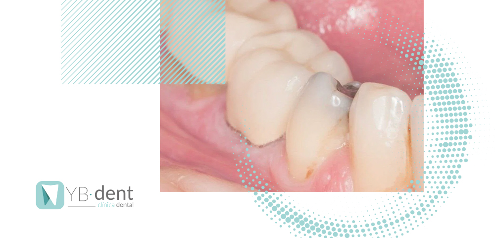 Qué son las caries interproximales y cuál es su tratamiento