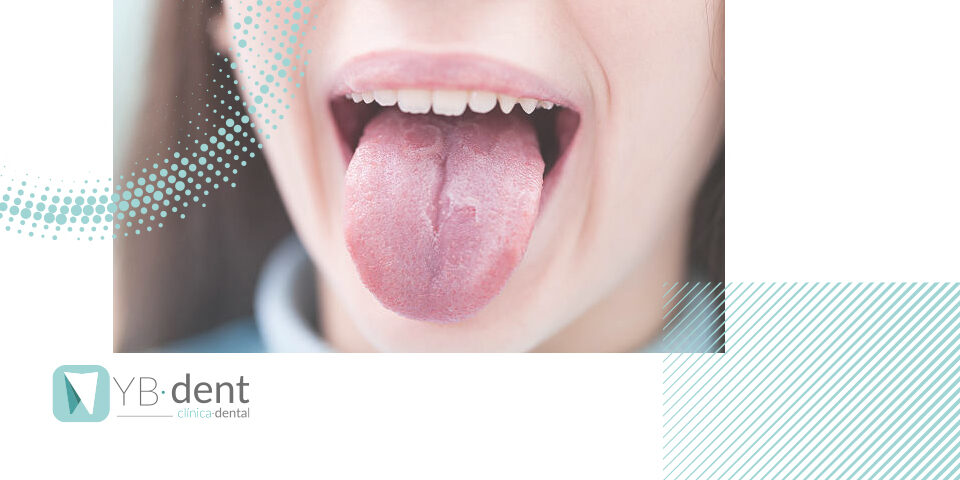 Qué son los granos en la lengua y cómo se quitan