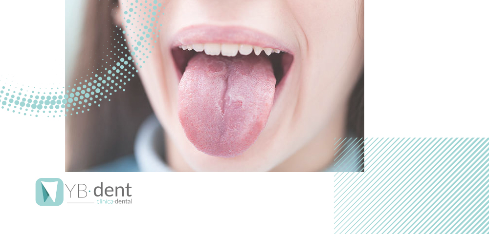 Qué son los granos en la lengua y cómo se quitan