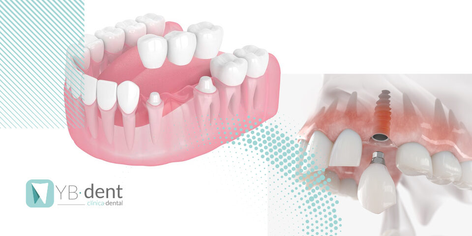 ¿Qué es mejor implante o puente dental