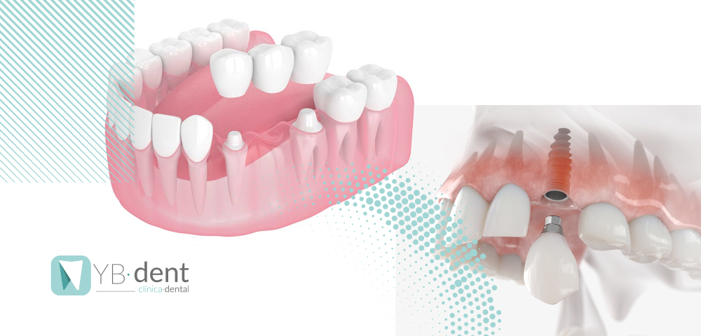 ¿Qué es mejor implante o puente dental